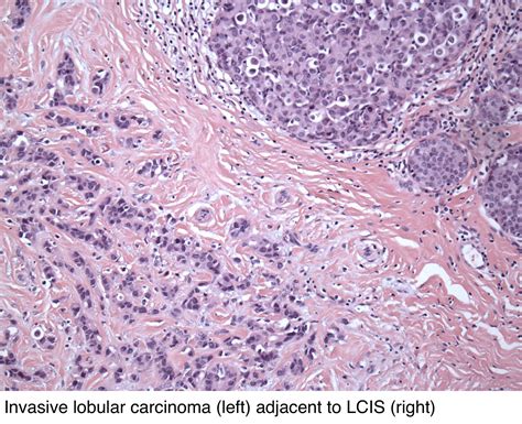 <b>Invasive</b> <b>lobular</b> <b>carcinoma</b> Microscopic (histologic) description Tumor cells arranged in single files, cords and single cells ( Breast Cancer Res 2015;17:12 ) Can be arranged concentrically around normal ducts, giving a targetoid appearance Tumor cells discohesive, small, monomorphic and lacking marked atypia. . Invasive lobular carcinoma pathology outlines
